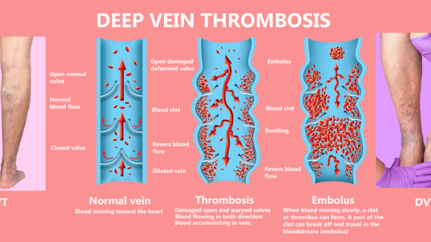 Deep Vein Thrombosis