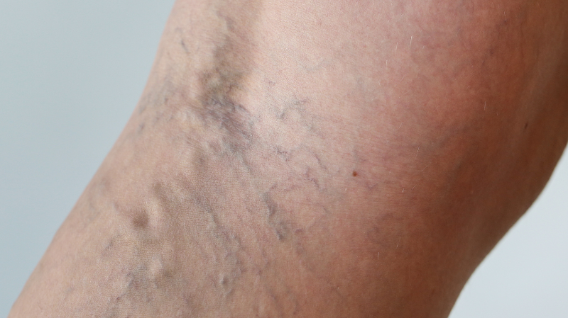 What Are Venous Disorders?