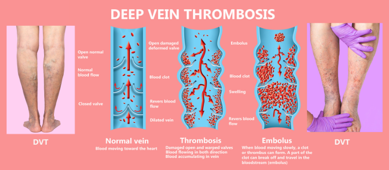 Deep Vein Thrombosis